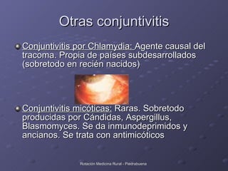 Otras conjuntivitis <ul><li>Conjuntivitis por Chlamydia:  Agente causal del tracoma. Propia de países subdesarrollados (so...