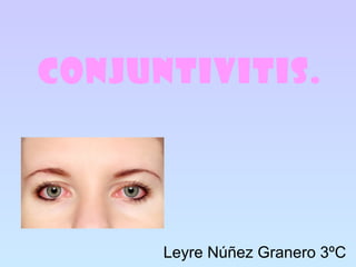 Conjuntivitis.
Leyre Núñez Granero 3ºC
 