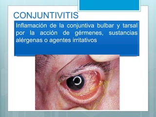 Inflamación de la conjuntiva bulbar y tarsal
por la acción de gérmenes, sustancias
alérgenas o agentes irritativos
CONJUNTIVITIS
 