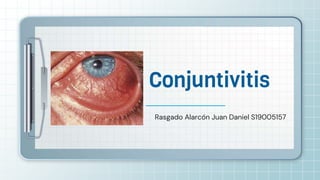 Rasgado Alarcón Juan Daniel S19005157
Conjuntivitis
 