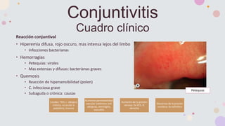 Reacción conjuntival
• Hiperemia difusa, rojo oscuro, mas intensa lejos del limbo
• Infecciones bacterianas
• Hemorragias
• Petequias: virales
• Mas extensas y difusas: bacterianas graves
• Quemosis
• Reacción de hipersensibilidad (polen)
• C. infecciosa grave
• Subaguda o crónica: causas
Conjuntivitis
Cuadro clínico
Locales: TED, c. alérgica
crónica, cx ocular o
palpebral, trauma
Aumento permeabilidad
vascular sistémica: enf.
alérgicas, meningitis,
vasculitis
Aumento de la presión
venosa: Sx VCS, IC
derecha
Descenso de la presión
oncótica: Sx nefrótico
Petequias
 