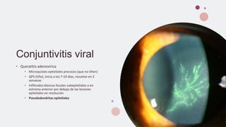 Conjuntivitis viral
• Queratitis adenovirica
• Microquistes epiteliales precoces (que no tiñen)
• QPS (tiñe), inicia a los 7-10 días, resuelve en 2
semanas
• Infiltrados blancos focales subepiteliales o en
estroma anterior por debajo de las lesiones
epiteliales en resolución
• Pseudodendritas epiteliales
 