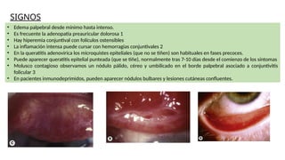 SIGNOS
• Edema palpebral desde mínimo hasta intenso.
• Es frecuente la adenopatía preauricular dolorosa 1
• Hay hiperemia conjuntival con folículos ostensibles
• La inflamación intensa puede cursar con hemorragias conjuntivales 2
• En la queratitis adenovirica los microquistes epiteliales (que no se tiñen) son habituales en fases precoces.
• Puede aparecer queratitis epitelial punteada (que se tiñe), normalmente tras 7-10 días desde el comienzo de los síntomas
• Molusco contagioso observamos un nódulo pálido, céreo y umbilicado en el borde palpebral asociado a conjuntivitis
folicular 3
• En pacientes inmunodeprimidos, pueden aparecer nódulos bulbares y lesiones cutáneas confluentes.
 