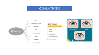 CONJUNTIVITIS
Sintomas
Lagrimeo
“Sensación de arenilla”
Punzadas
Ardor
Prurito (alergias)
Dolor
Fotofobia
Cuerpo extraño
Secreción
Acuosa
Mucoide
Mucopurulenta
Purulenta moderada
Purulenta intensa
 