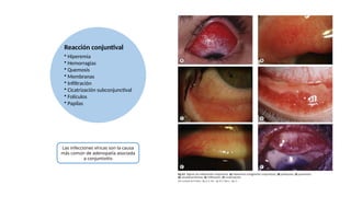 Reacción conjuntival
• Hiperemia
• Hemorragias
• Quemosis
• Membranas
• Infiltración
• Cicatrización subconjunctival
• Folículos
• Papilas
Las infecciones víricas son la causa
más común de adenopatía asociada
a conjuntivitis
 