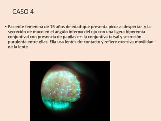 CASO 4
• Paciente femenina de 15 años de edad que presenta picor al despertar y la
secreción de moco en el angulo interno del ojo con una ligera hiperemia
conjuntival con presencia de papilas en la conjuntiva tarsal y secreción
purulenta entre ellas. Ella usa lentes de contacto y refiere excesiva movilidad
de la lente
 