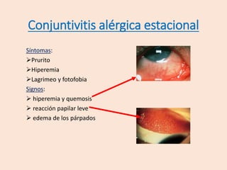 Síntomas:
Prurito
Hiperemia
Lagrimeo y fotofobia
Signos:
 hiperemia y quemosis
 reacción papilar leve
 edema de los párpados
Conjuntivitis alérgica estacional
 