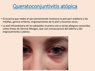 • El eccema que rodea al ojo comúnmente involucra la piel peri-orbitaria y las
mejillas, genera eritema, engrosamiento de la piel y escamas secas.
• La piel infraorbitaria de los párpados muestra uno o varios pliegues conocidos
como líneas de Dennie-Morgan, que son consecuencia del edema y del
engrosamiento cutáneo.
Queratoconjuntivitis atópica
 