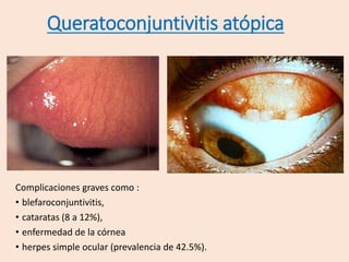 Complicaciones graves como :
• blefaroconjuntivitis,
• cataratas (8 a 12%),
• enfermedad de la córnea
• herpes simple ocular (prevalencia de 42.5%).
Queratoconjuntivitis atópica
 