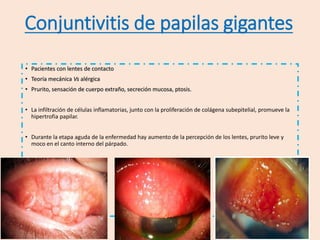 Conjuntivitis de papilas gigantes
• Pacientes con lentes de contacto
• Teoría mecánica Vs alérgica
• Prurito, sensación de cuerpo extraño, secreción mucosa, ptosis.
• La infiltración de células inflamatorias, junto con la proliferación de colágena subepitelial, promueve la
hipertrofia papilar.
• Durante la etapa aguda de la enfermedad hay aumento de la percepción de los lentes, prurito leve y
moco en el canto interno del párpado.
 