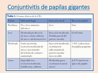 Conjuntivitis de papilas gigantes
 