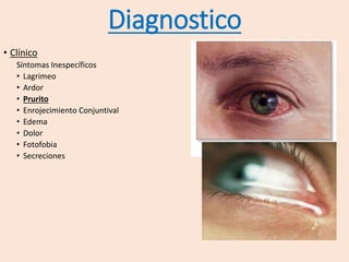 Diagnostico
• Clínico
Síntomas Inespecíficos
• Lagrimeo
• Ardor
• Prurito
• Enrojecimiento Conjuntival
• Edema
• Dolor
• Fotofobia
• Secreciones
 