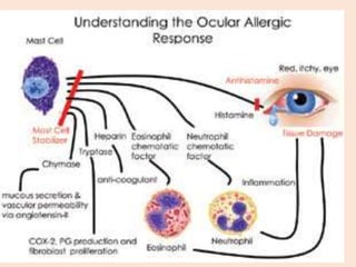 Conjuntivitis alergica
