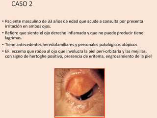 CASO 2
• Paciente masculino de 33 años de edad que acude a consulta por presenta
irritación en ambos ojos.
• Refiere que siente el ojo derecho inflamado y que no puede producir tiene
lagrimas.
• Tiene antecedentes heredofamiliares y personales patológicos atópicos
• EF: eccema que rodea al ojo que involucra la piel peri-orbitaria y las mejillas,
con signo de hertoghe positivo, presencia de eritema, engrosamiento de la piel
 
