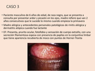 CASO 3
• Paciente masculino de 6 años de edad, de raza negra, que se presenta a
consulta por presentar ardor y picazón en los ojos, madre refiere que van 2
años consecutivos que le sucede lo mismo cuando empieza la primavera
• Madre alérgica y antecedentes personales patológicos de rinitis alérgica y
dermatitis atópica cuando fue lactante
• EF: Presenta, prurito ocular, fotofobia y sensación de cuerpo extraño, con una
secreción filamentosa espesa con presencia de papilas en la conjuntiva limbar
que tiene apariencia recubierta de moco con puntos de Horner-Tranta
 