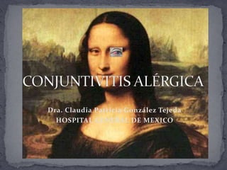 CONJUNTIVITIS ALÉRGICA Dra. Claudia Patricia González Tejeda HOSPITAL GENERAL DE MEXICO 