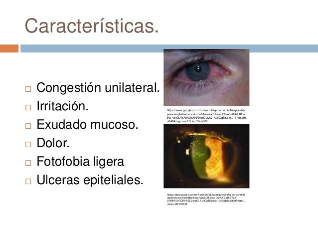 Conjuntivitis bacteriana