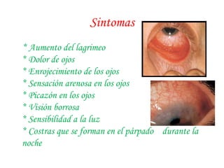Sintomas * Aumento del lagrimeo * Dolor de ojos * Enrojecimiento de los ojos * Sensación arenosa en los ojos * Picazón en los ojos * Visión borrosa * Sensibilidad a la luz * Costras que se forman en el párpado  durante la noche 