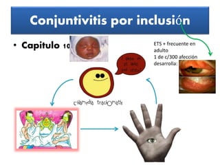 Conjuntivitis por inclusión 
• Capitulo 10 ETS + frecuente en 
adulto 
1 de c/300 afección 
desarrolla: 
 