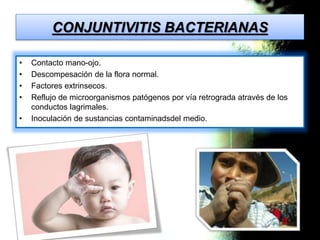 CONJUNTIVITIS BACTERIANAS 
• Contacto mano-ojo. 
• Descompesación de la flora normal. 
• Factores extrinsecos. 
• Reflujo ...