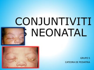 CONJUNTIVITI
S NEONATAL
GRUPO 5
CATEDRA DE PEDIATRIA
 