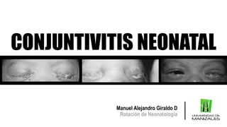 CONJUNTIVITIS NEONATAL
Manuel Alejandro Giraldo D
Rotación de Neonatología
 