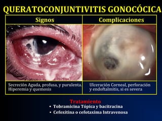 Conjuntivitis | PPT