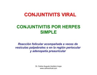 CONJUNTIVITS VIRAL

 CONJUNTIVITIS POR HERPES
         SIMPLE

  Reacción folicular acompañada a veces de
vesículas palpeb...