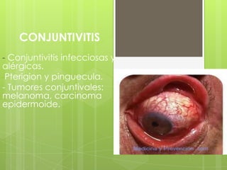 CONJUNTIVITIS
- Conjuntivitis infecciosas y
alérgicas.
-Pterigion y pinguecula.
- Tumores conjuntivales:
melanoma, carcinoma
epidermoide.
 