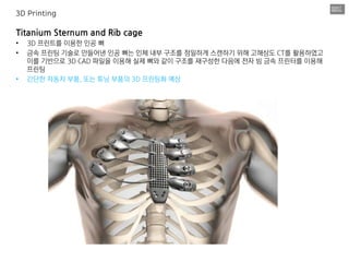 Titanium Sternum and Rib cage
• 3D 프린트를 이용한 인공 뼈
• 금속 프린팅 기술로 만들어낸 인공 뼈는 인체 내부 구조를 정밀하게 스캔하기 위해 고해상도 CT를 활용하였고
이를 기반으로 3D CAD 파일을 이용해 실제 뼈와 같이 구조를 재구성한 다음에 전자 빔 금속 프린터를 이용해
프린팅
• 간단한 자동차 부품, 또는 튜닝 부품의 3D 프린팅화 예상
3D Printing
 