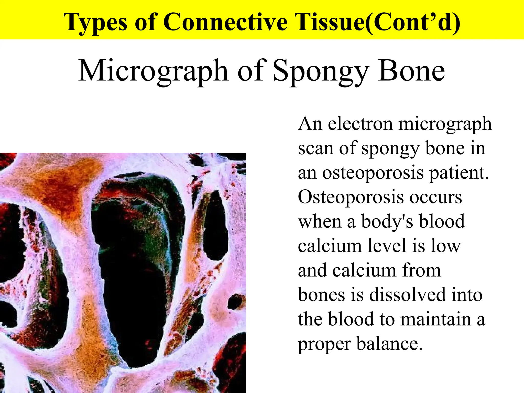 Micrograph of Spongy Bone
An electron micrograph
scan of spongy bone in
an osteoporosis patient.
Osteoporosis occurs
when a body's blood
calcium level is low
and calcium from
bones is dissolved into
the blood to maintain a
proper balance.
Types of Connective Tissue(Cont’d)
 