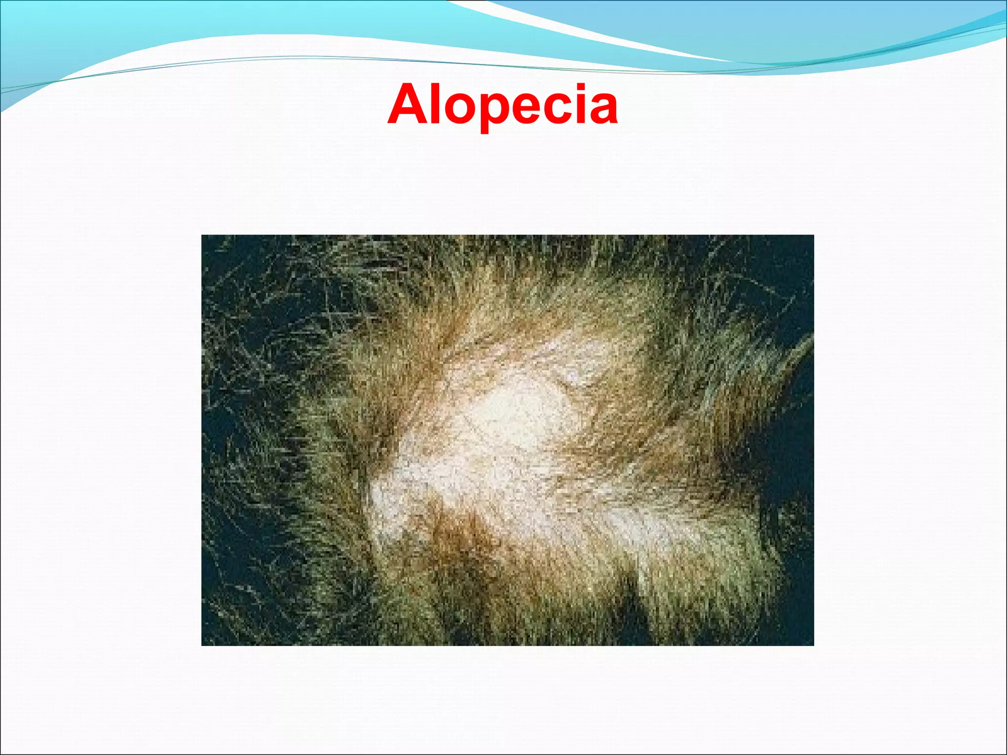 Alopecia
 
