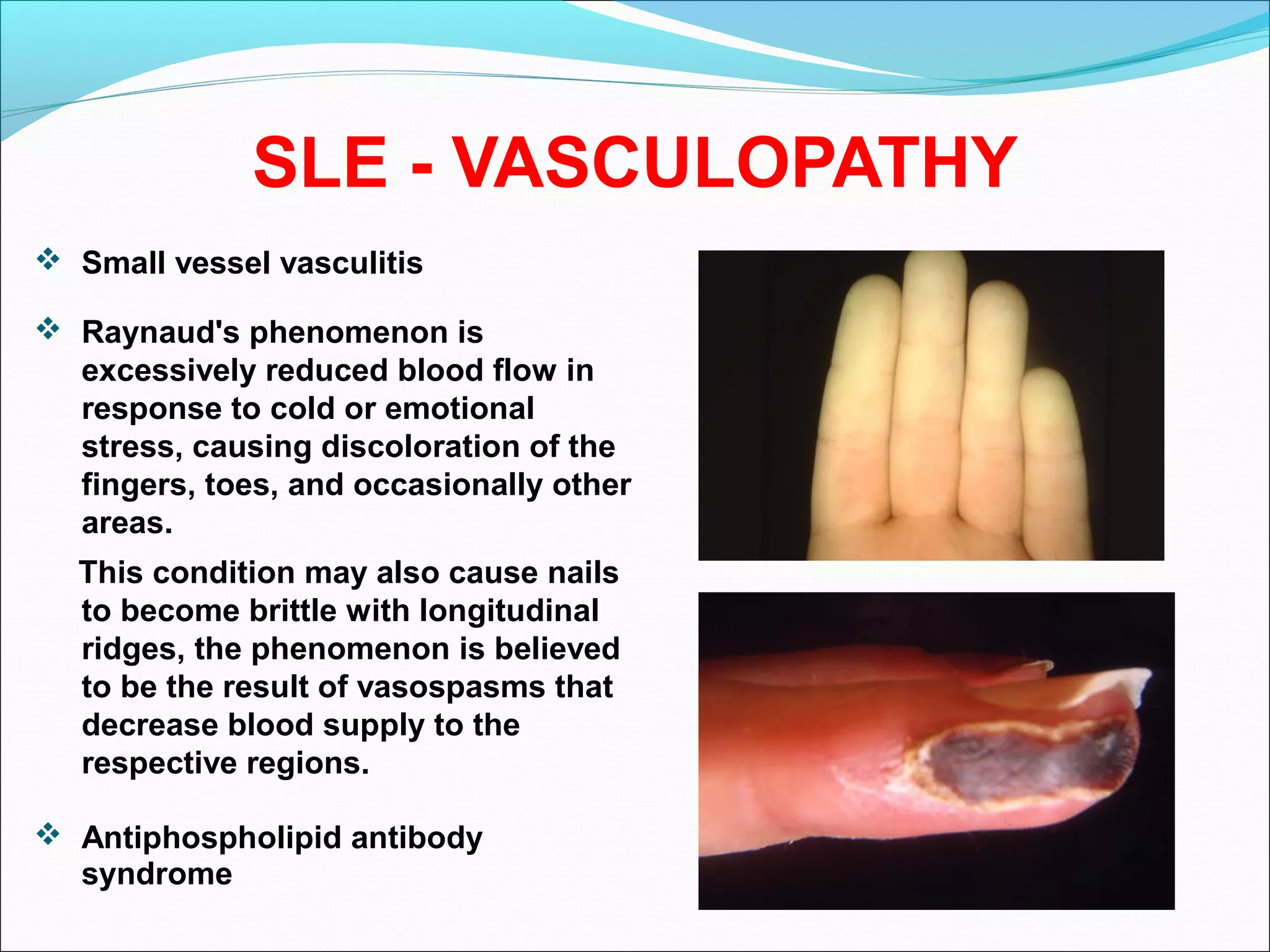 SLE - VASCULOPATHY
 Small vessel vasculitis
 Raynaud's phenomenon is
excessively reduced blood flow in
response to cold or emotional
stress, causing discoloration of the
fingers, toes, and occasionally other
areas.
This condition may also cause nails
to become brittle with longitudinal
ridges, the phenomenon is believed
to be the result of vasospasms that
decrease blood supply to the
respective regions.
 Antiphospholipid antibody
syndrome
 