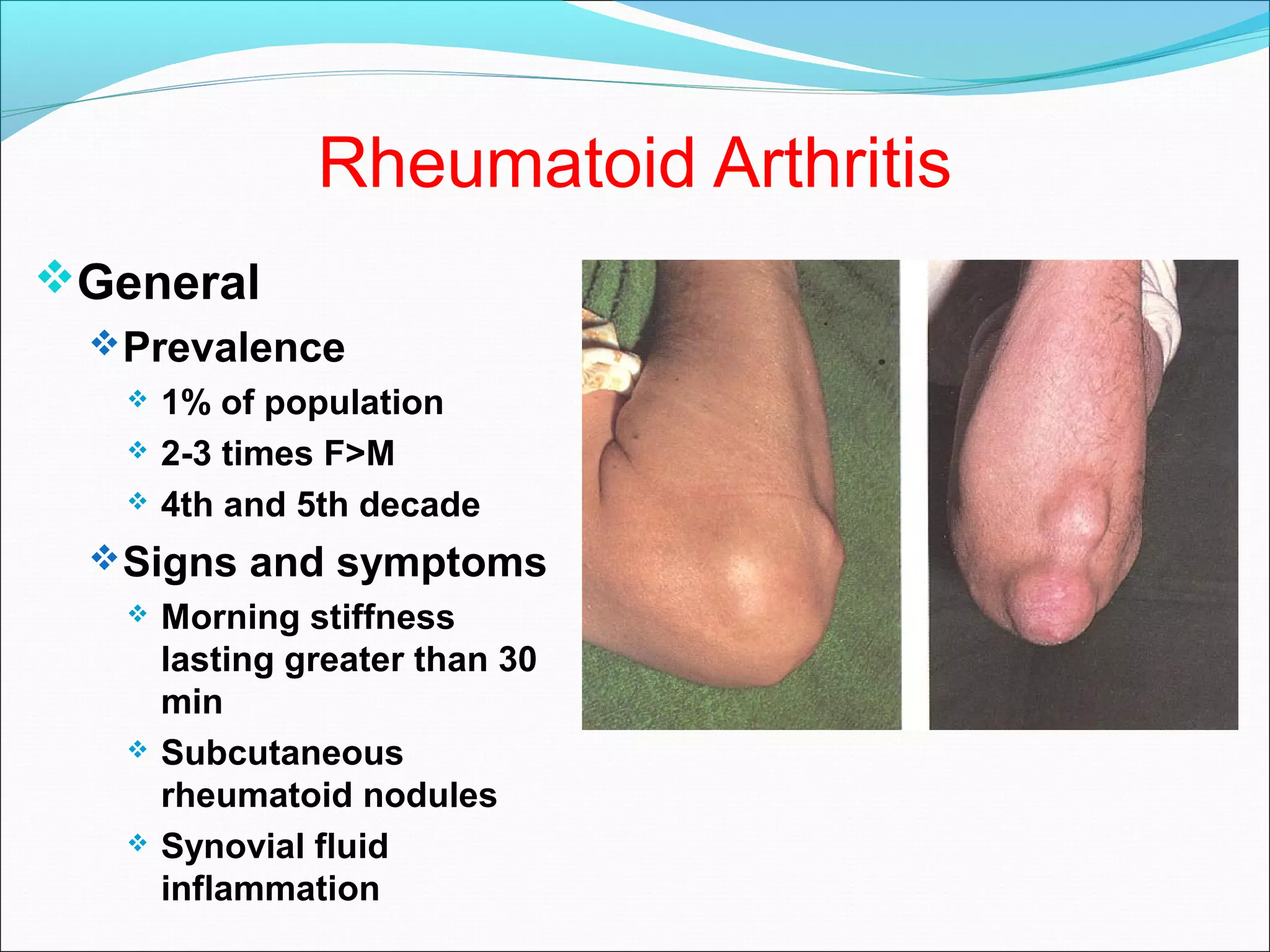 Rheumatoid Arthritis
General
Prevalence
 1% of population
 2-3 times F>M
 4th and 5th decade
Signs and symptoms
 Morning stiffness
lasting greater than 30
min
 Subcutaneous
rheumatoid nodules
 Synovial fluid
inflammation
 
