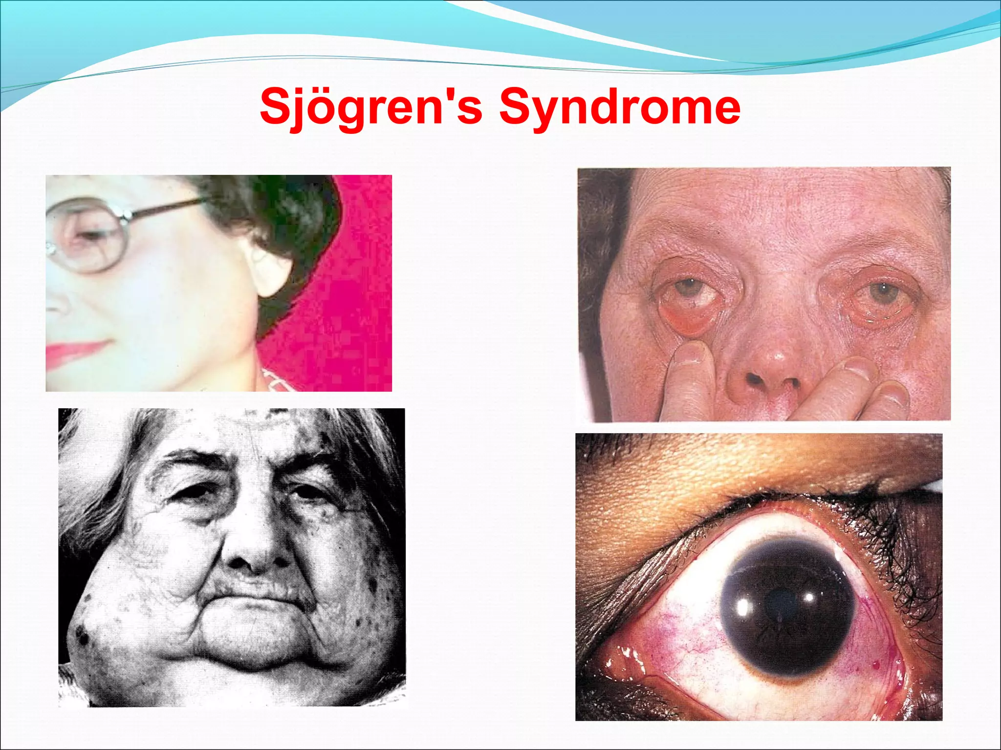 Sjögren's Syndrome
 