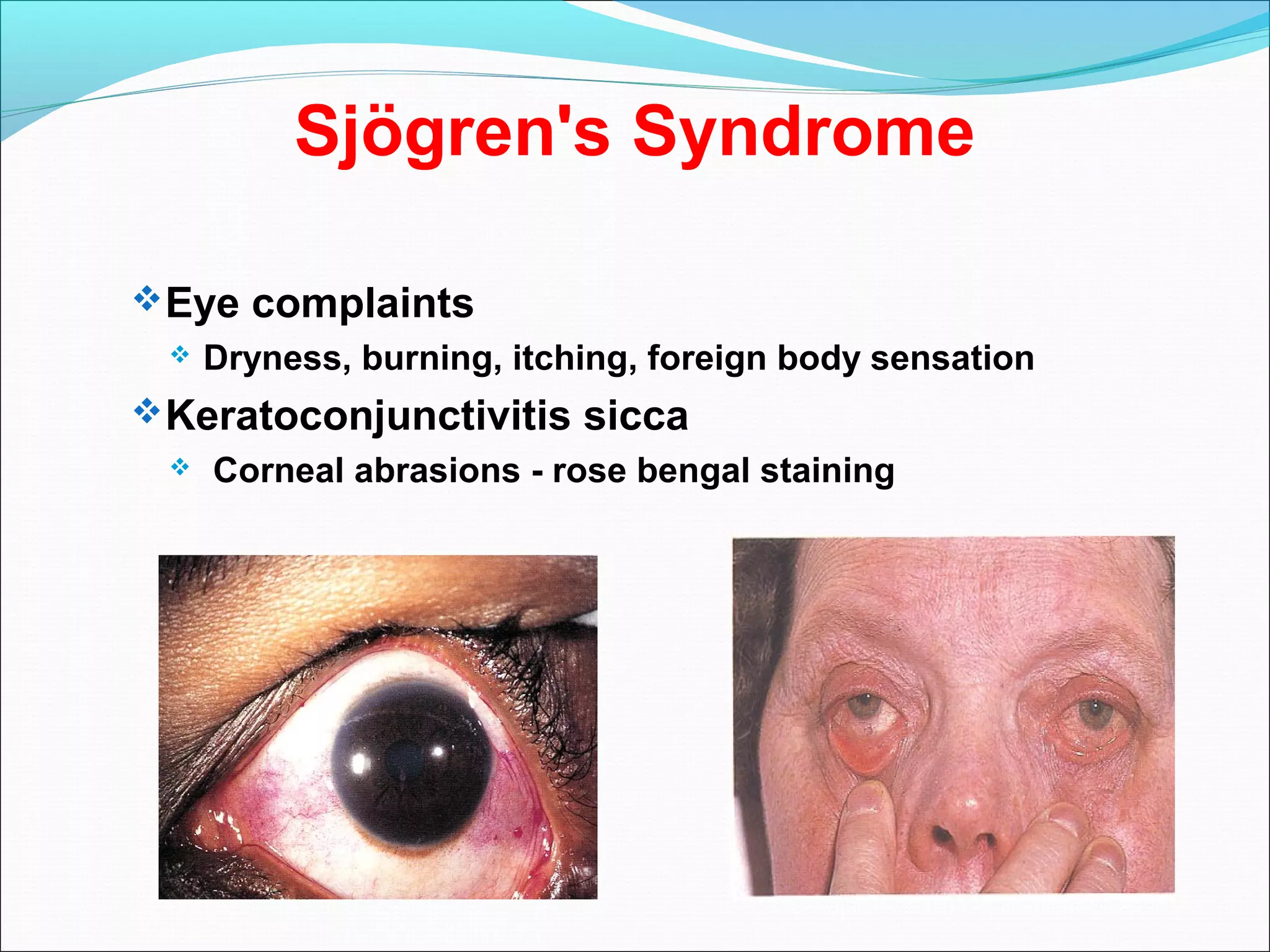 Sjögren's Syndrome
Eye complaints
 Dryness, burning, itching, foreign body sensation
Keratoconjunctivitis sicca
 Corneal abrasions - rose bengal staining
 