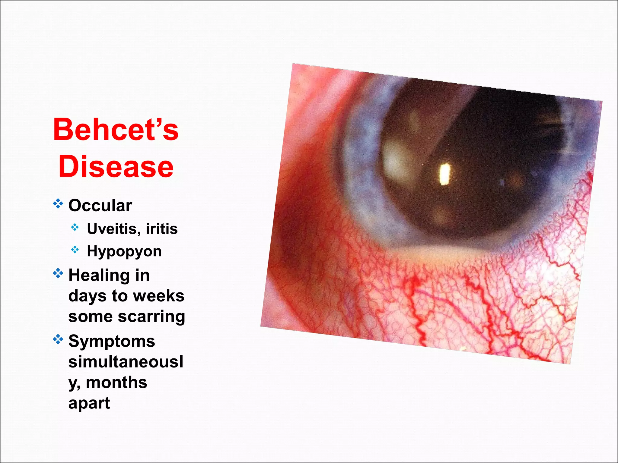 Behcet’s
Disease
 Occular
 Uveitis, iritis
 Hypopyon
 Healing in
days to weeks
some scarring
 Symptoms
simultaneousl
y, months
apart
 