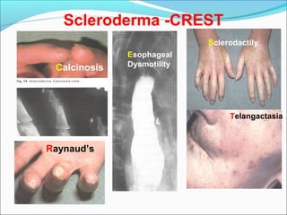 Connective tissue diseases (7) | PPT