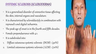 • It is a generalised disorder of connective tissue affecting
the skin, internal organs and vasculature.
• It is characterized by scleroddactyly in combination with
raynaud's and digital ischaemia.
• The peak age of onset is in the fourth and fifth decades.
• Female prepondaerance with 4:1.
• It is subdivided into:
1. Diffuse cutaneous systemic sclerosis (DCSS) : (30%)
2. Limited cutaneous systemic sclerosis ( LCSS) : (70%)
 