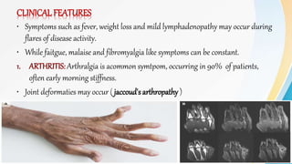 CLINICAL FEATURES
• Symptoms such as fever, weight loss and mild lymphadenopathy may occur during
flares of disease activity.
• While faitgue, malaise and fibromyalgia like symptoms can be constant.
1. ARTHRITIS: Arthralgia is acommon symtpom, occurring in 90% of patients,
often early morning stiffness.
• Joint deformaties may occur ( jaccoud's arthropathy )
 