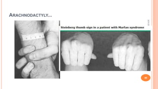 ARACHNODACTYLY...
3/31/2021
40
 