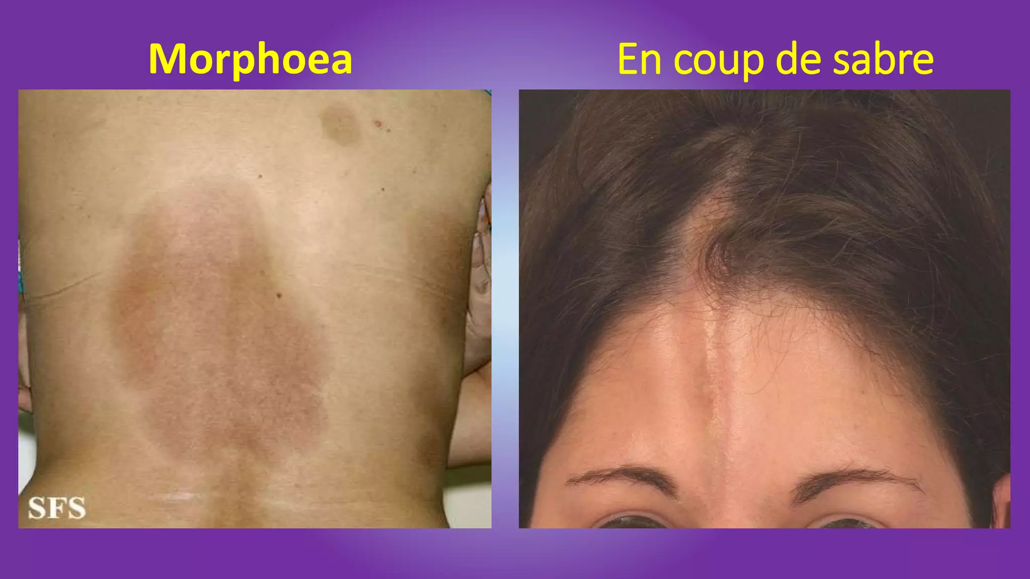 Connective Tissue Disorders.pptx