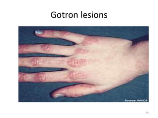 Gotron lesions
30
 