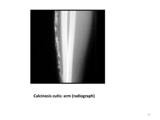 Calcinosis cutis: arm (radiograph)
52
 