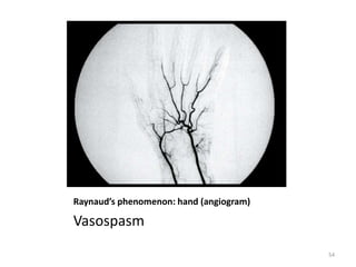 Raynaud’s phenomenon: hand (angiogram)
Vasospasm
54
 