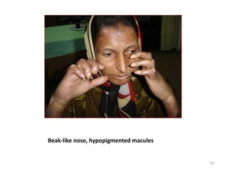 Beak-like nose, hypopigmented macules
65
 