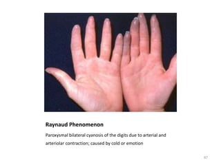 Raynaud Phenomenon
Paroxysmal bilateral cyanosis of the digits due to arterial and
arteriolar contraction; caused by cold or emotion
87
 