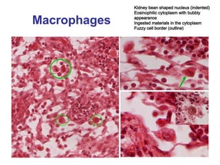 Macrophages
Kidney bean shaped nucleus (indented)
Eosinophilic cytoplasm with bubbly
appearance
Ingested materials in the cytoplasm
Fuzzy cell border (outline)
 