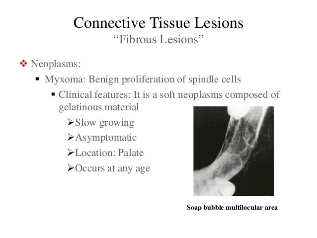 malignancy of connective tissue Connective tissue lesions malignancy of connective tissue Connective tissue lesions