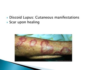  Discoid Lupus: Cutaneous manifestations
 Scar upon healing
 